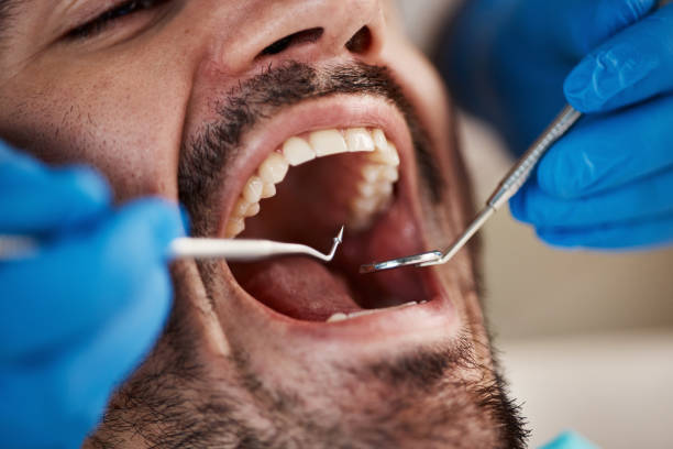 Best Dentist for Tooth Abscess  in Fairview Park, OH